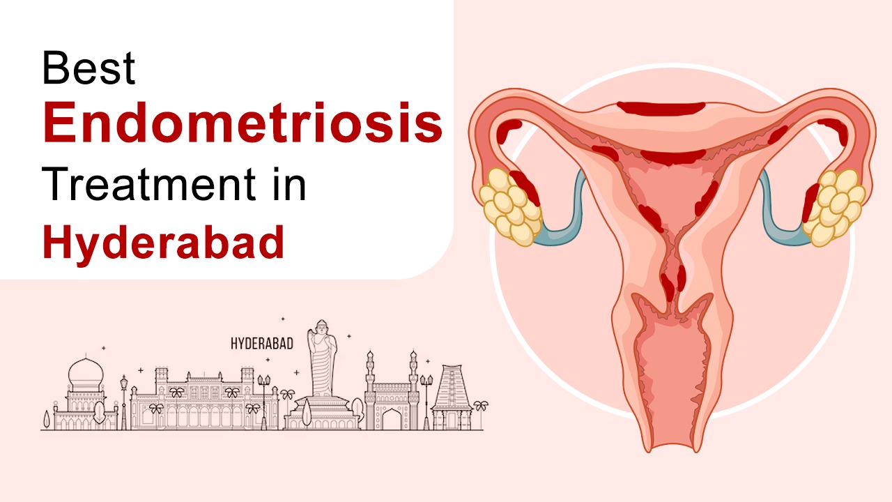 Best Endometriosis Treatment in Hyderabad